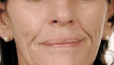 mesoterapia-facial-antes