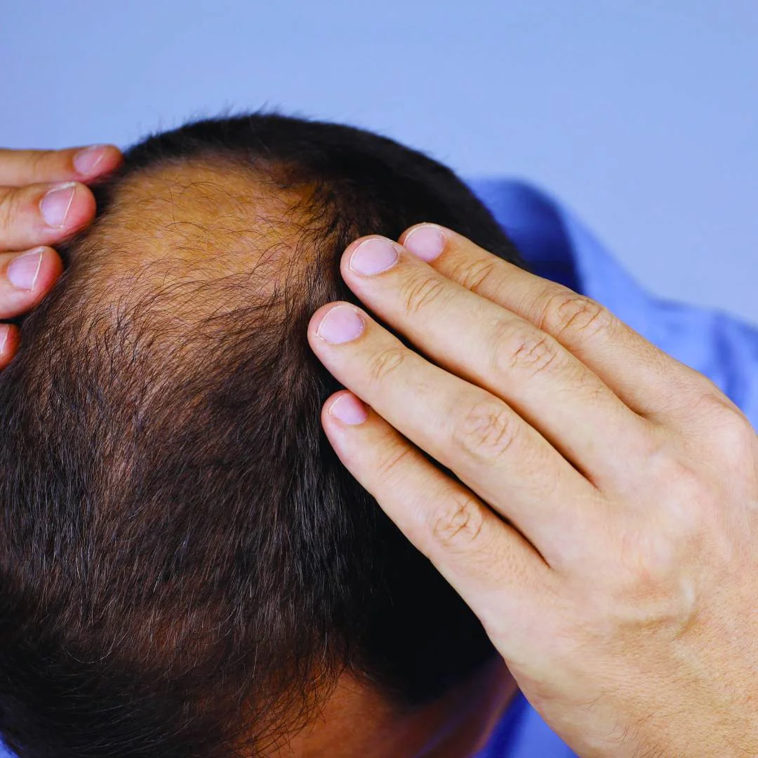 Evaluación capilar previa al microinjerto