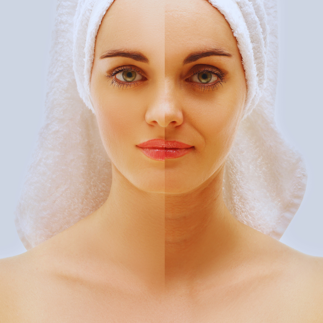 Resultados y cuidados en carboxiterapia facial